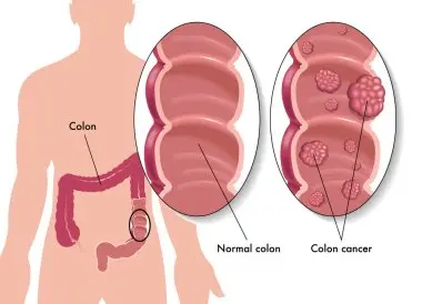 colon-cancer