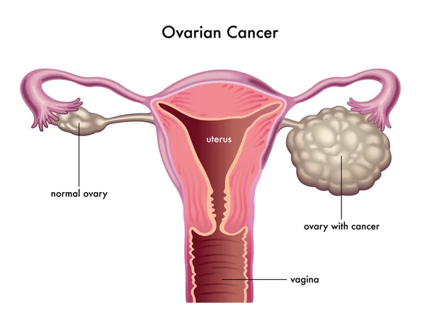 Ovarian Cancer: A Closer Look at Its Symptoms