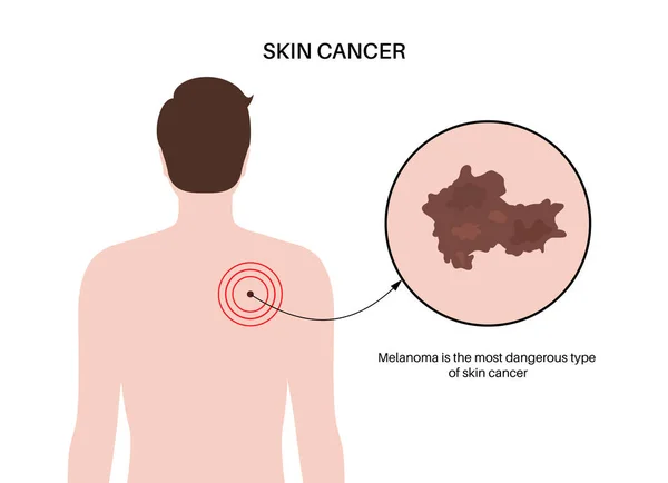 skin cancer