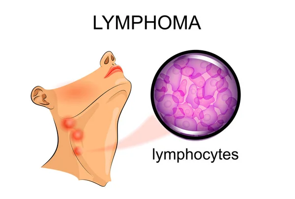 lymphoma