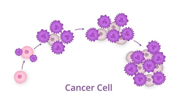 Stages of Cancer