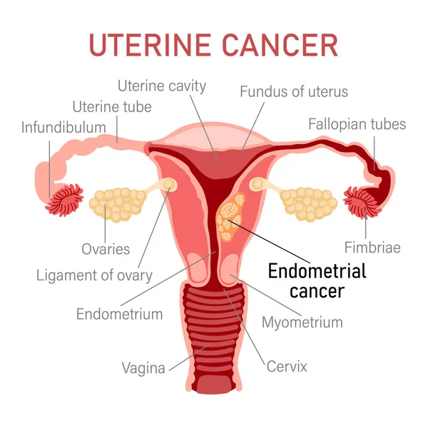 Uterine Cancer