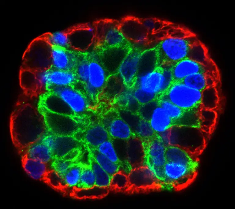 How Serious is Luminal B Breast Cancer?